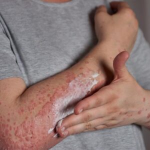 Psoriasis & Eczema (Kushtha)