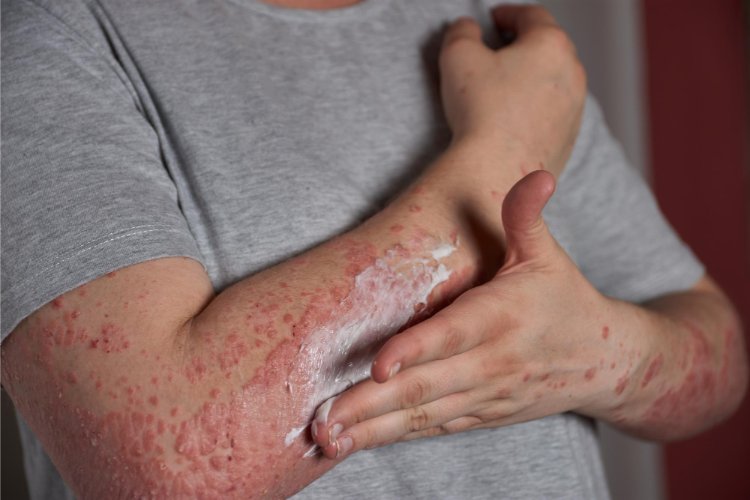 Psoriasis & Eczema (Kushtha)